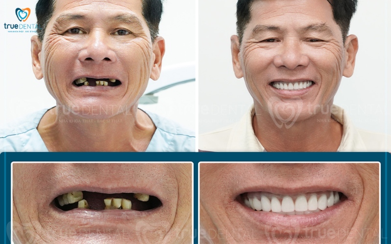 Thời gian hồi phục sau cấy ghép implant toàn hàm 2 Thời gian hồi phục sau cấy ghép implant toàn hàm
