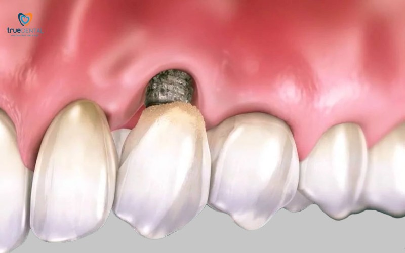 Cách chăm sóc implant sau phẫu thuật tại nhà