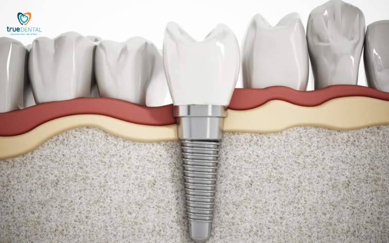 Cách chăm sóc implant sau phẫu thuật tại nhà