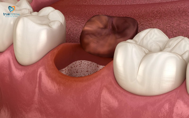 Cách chăm sóc implant sau phẫu thuật tại nhà