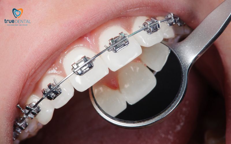 cách nhận biết niềng răng chất lượng