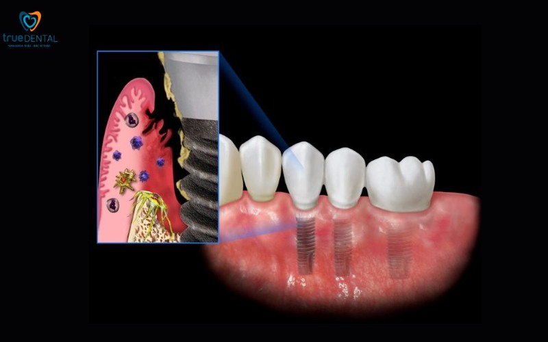 Cách nhận biết trụ implant chất lượng cao: Bí quyết lựa chọn tốt nhất 1 cách nhận biết trụ implant chất lượng cao