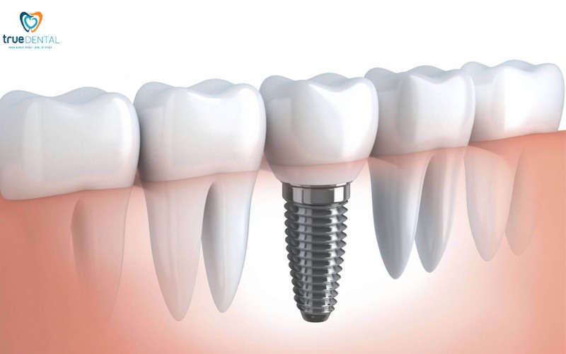 Cách nhận biết trụ implant chất lượng cao: Bí quyết lựa chọn tốt nhất 8 cách nhận biết trụ implant chất lượng cao