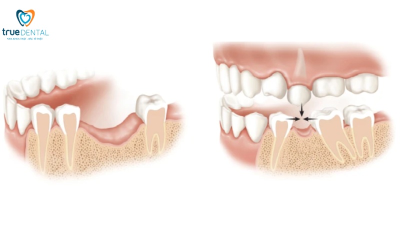 Cấy ghép implant cho người bị loãng xương: Giải pháp an toàn và hiệu quả 1 cấy ghép implant cho người bị loãng xương