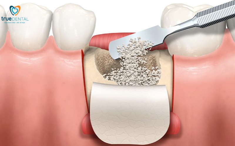Cấy ghép implant cho người bị loãng xương: Giải pháp an toàn và hiệu quả 4 cấy ghép implant cho người bị loãng xương