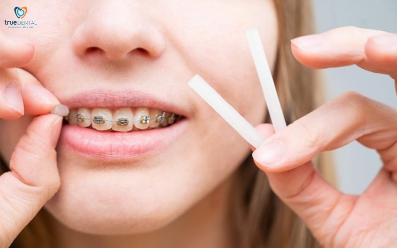 Chế độ ăn sau niềng răng 1 tháng: Hướng dẫn chi tiết cho người mới bắt đầu 4 chế độ ăn uống sau niềng răng 1 tháng