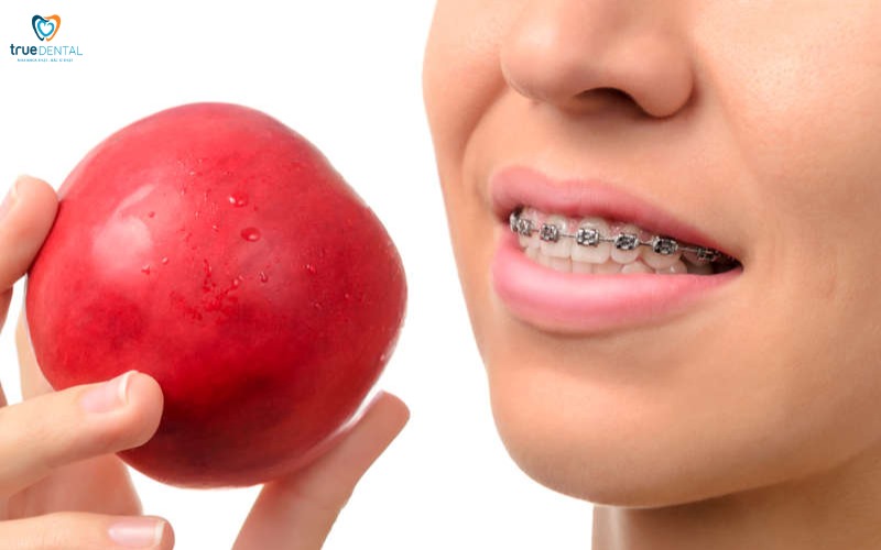 Chế độ ăn sau niềng răng 1 tháng: Hướng dẫn chi tiết cho người mới bắt đầu 5 chế độ ăn uống sau niềng răng 1 tháng