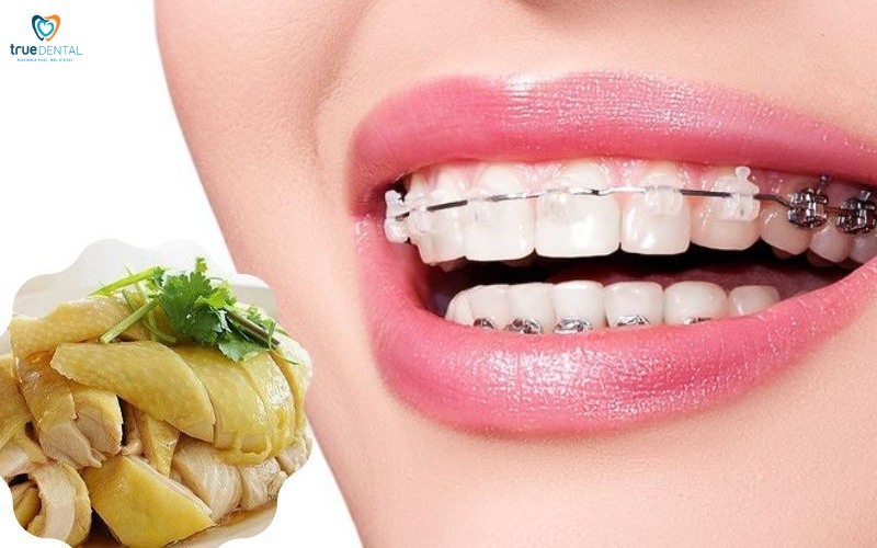 Chế độ ăn sau niềng răng 1 tháng: Hướng dẫn chi tiết cho người mới bắt đầu 6 chế độ ăn uống sau niềng răng 1 tháng