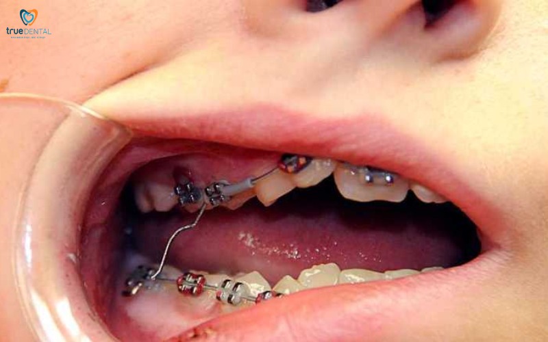 Chế độ ăn sau niềng răng 1 tháng: Hướng dẫn chi tiết cho người mới bắt đầu 7 chế độ ăn uống sau niềng răng 1 tháng