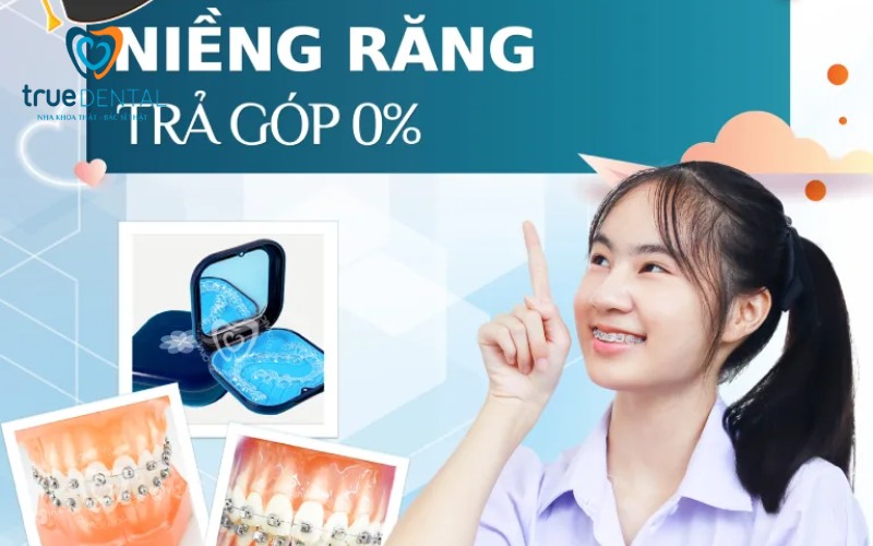 chi phí niềng răng mắc cài tự buộc tại tp.hcm