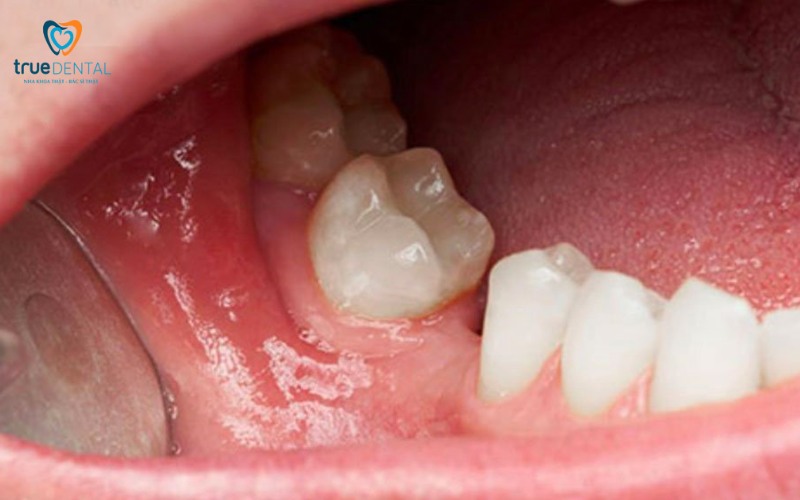 Lợi ích cấy ghép implant cho nụ cười thẩm mỹ hoàn hảo 2 Lợi ích cấy ghép implant cho nụ cười thẩm mỹ