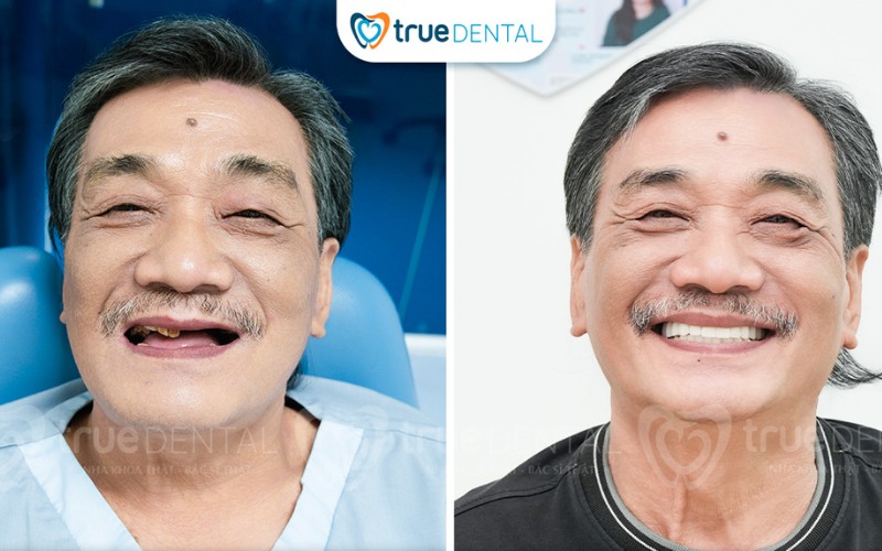 Lợi ích cấy ghép implant cho nụ cười thẩm mỹ hoàn hảo 4 Lợi ích cấy ghép implant cho nụ cười thẩm mỹ