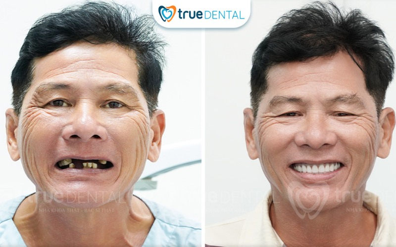 Lợi ích cấy ghép implant cho nụ cười thẩm mỹ hoàn hảo 8 Lợi ích cấy ghép implant cho nụ cười thẩm mỹ