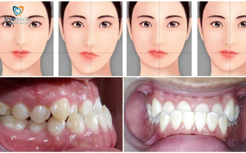 niềng răng có ảnh hưởng phát âm không