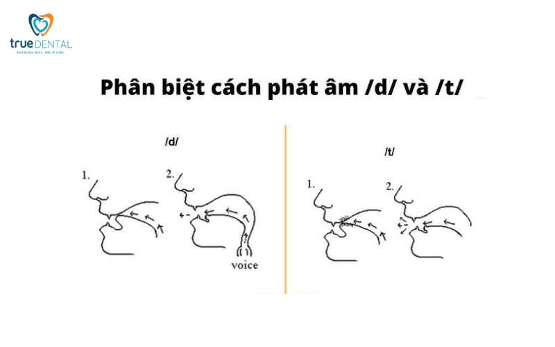 niềng răng có ảnh hưởng phát âm không