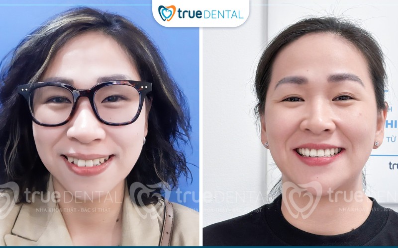 niềng răng có ảnh hưởng phát âm không