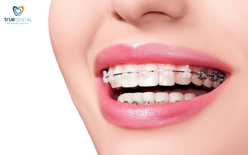 niềng răng có ảnh hưởng phát âm không