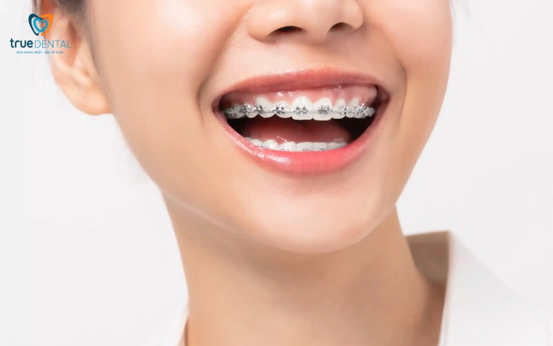 niềng răng có ảnh hưởng phát âm không