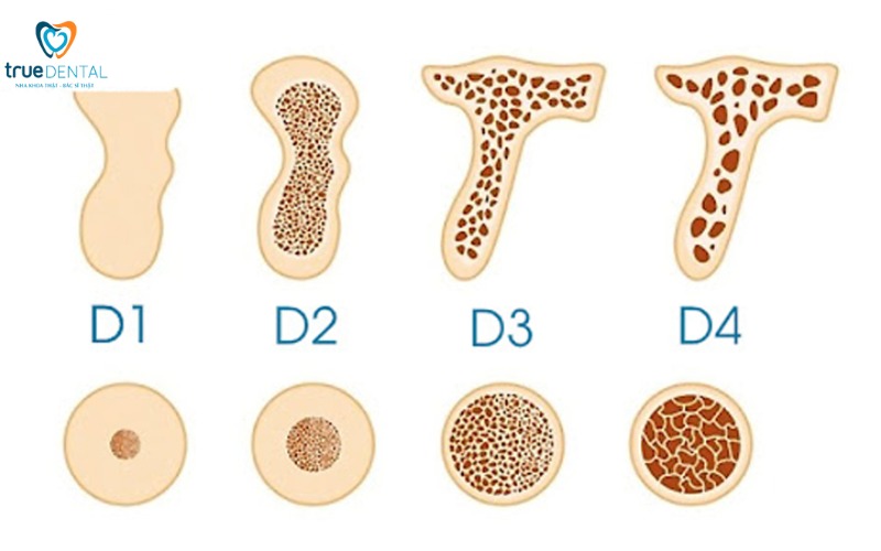 Thời gian chờ tích hợp xương sau cấy implant: Những điều cần biết! 2 thời gian chờ tích hợp xương sau cấy implant