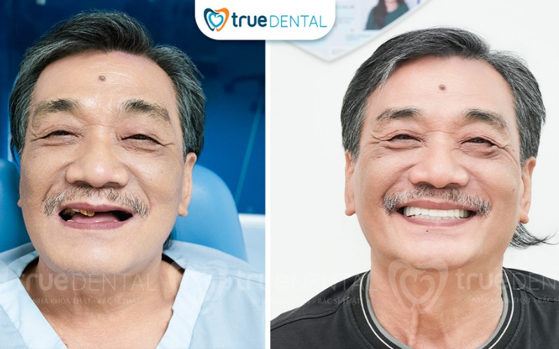 Thời gian chờ tích hợp xương sau cấy implant: Những điều cần biết! 5 thời gian chờ tích hợp xương sau cấy implant