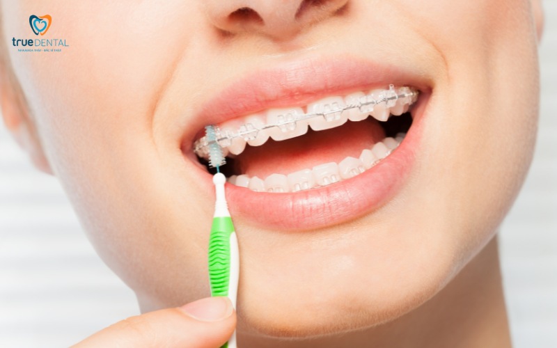 Top địa chỉ niềng răng giá rẻ tại tp.hcm