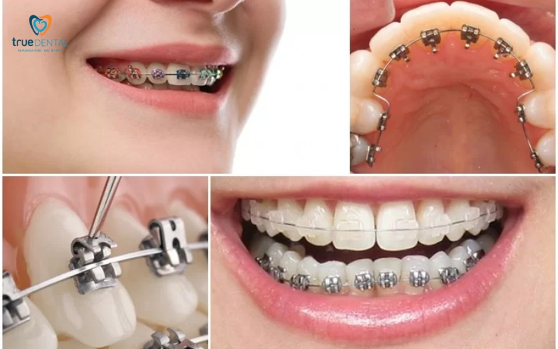 Top địa chỉ niềng răng giá rẻ tại tp.hcm