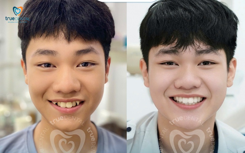 Top địa chỉ niềng răng giá rẻ tại tp.hcm