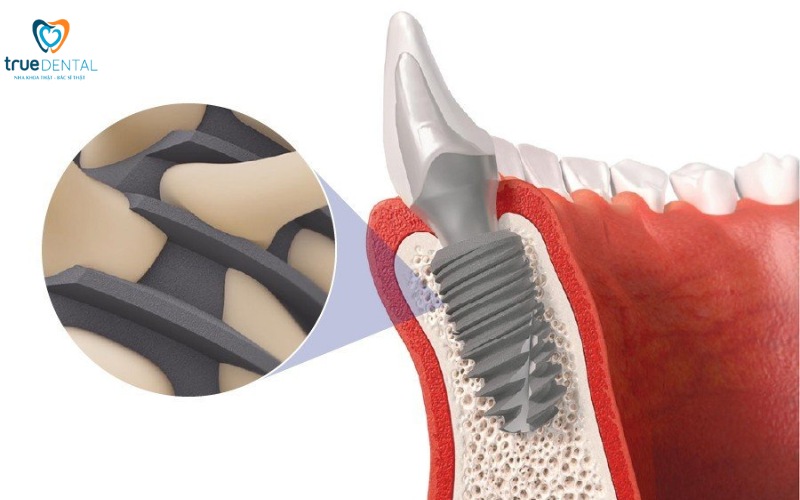 Ưu điểm trụ implant Nobel Biocare: Lựa chọn hàng đầu cho răng giả 3 ưu điểm trụ implant nobel biocare