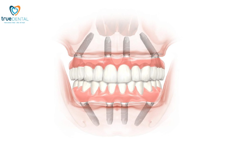 Ưu điểm trụ implant Nobel Biocare: Lựa chọn hàng đầu cho răng giả 4 ưu điểm trụ implant nobel biocare