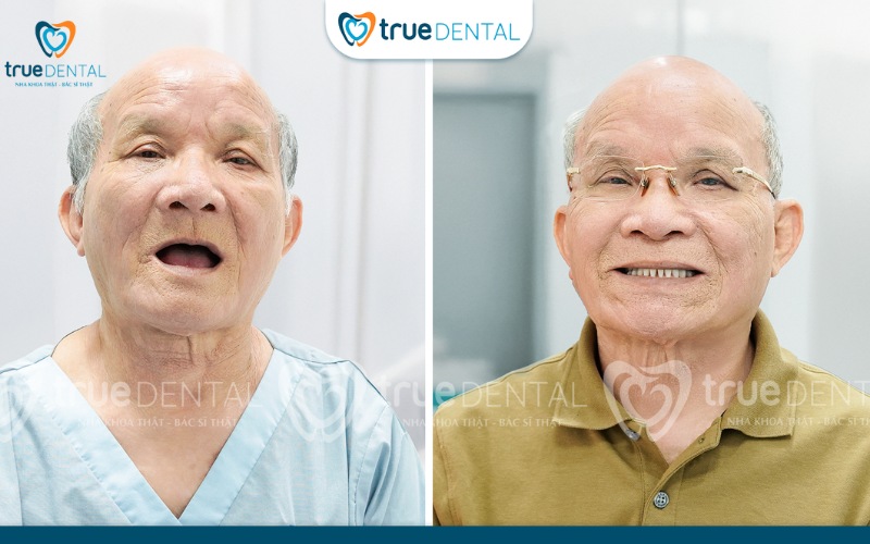 Ưu điểm trụ implant Nobel Biocare: Lựa chọn hàng đầu cho răng giả 5 ưu điểm trụ implant nobel biocare