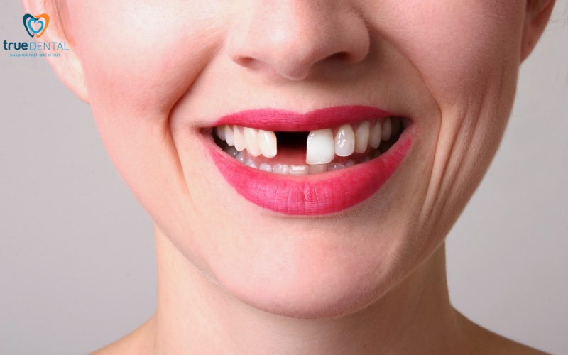 Ưu điểm trụ implant Nobel Biocare: Lựa chọn hàng đầu cho răng giả 6 ưu điểm trụ implant nobel biocare