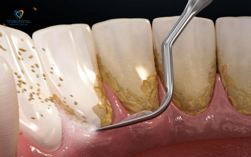 cách nhận biết dấu hiệu viêm lợi sớm