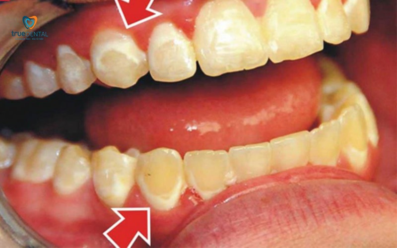 cách nhận biết dấu hiệu viêm lợi sớm