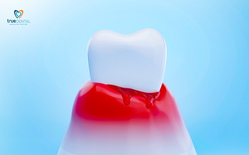 cách nhận biết dấu hiệu viêm lợi sớm