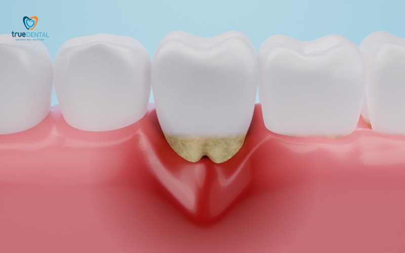cách nhận biết dấu hiệu viêm lợi sớm