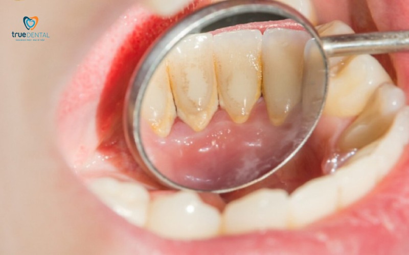 cách nhận biết dấu hiệu viêm lợi sớm