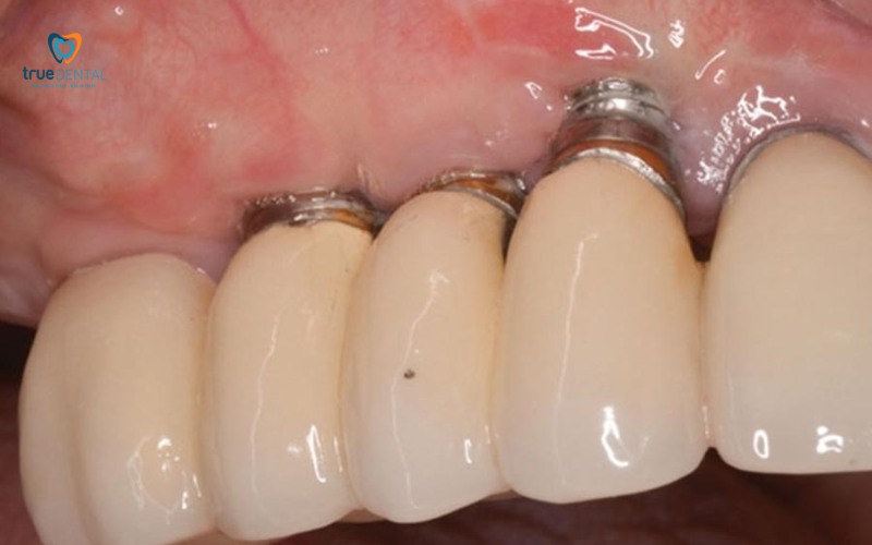 Cấy ghép implant có đau khi ăn nhai không? Giải đáp từ chuyên gia 5 cấy ghép implant có đau khi ăn nhai không
