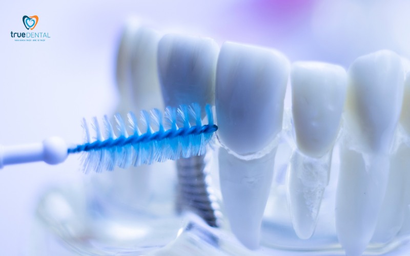 Cấy ghép implant có đau khi ăn nhai không? Giải đáp từ chuyên gia 6 cấy ghép implant có đau khi ăn nhai không