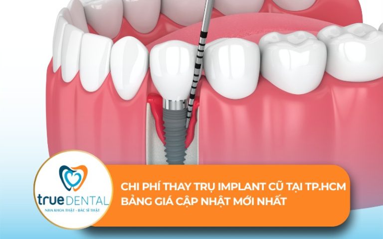 chi phí thay trụ implant cũ tại tphcm