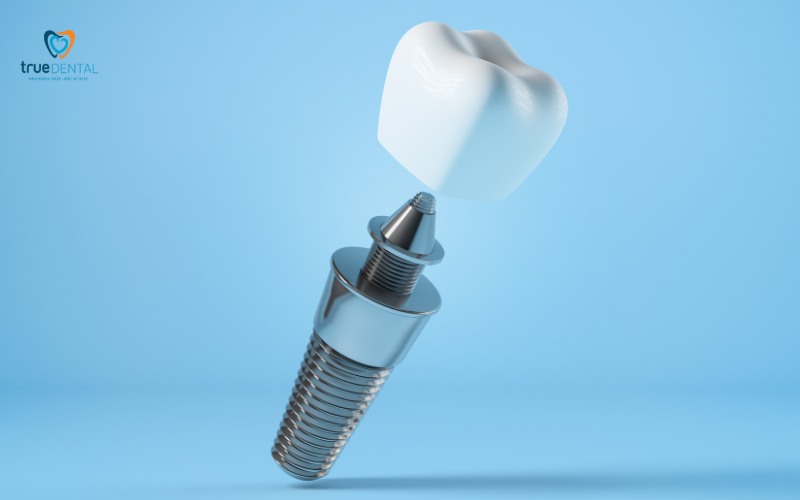 chi phí thay trụ implant cũ tại tp.hcm