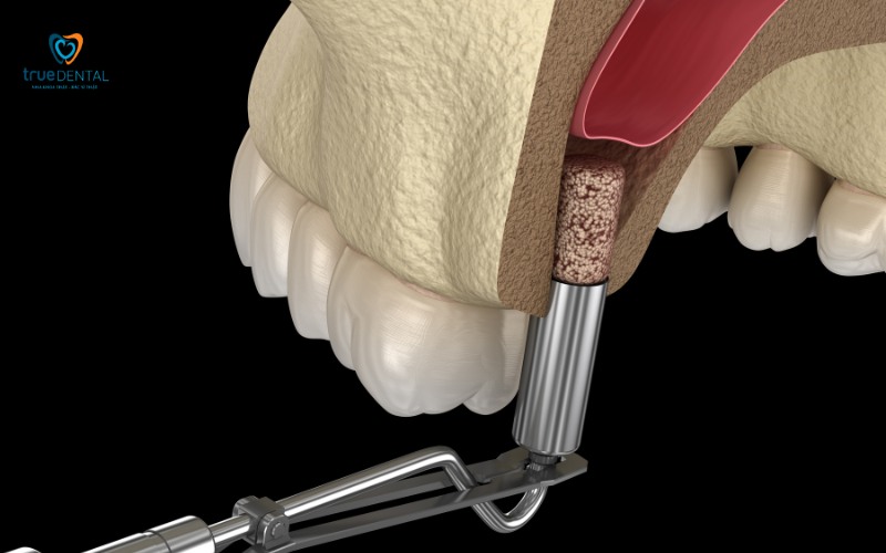 chi phí thay trụ implant cũ tại TP.HCM