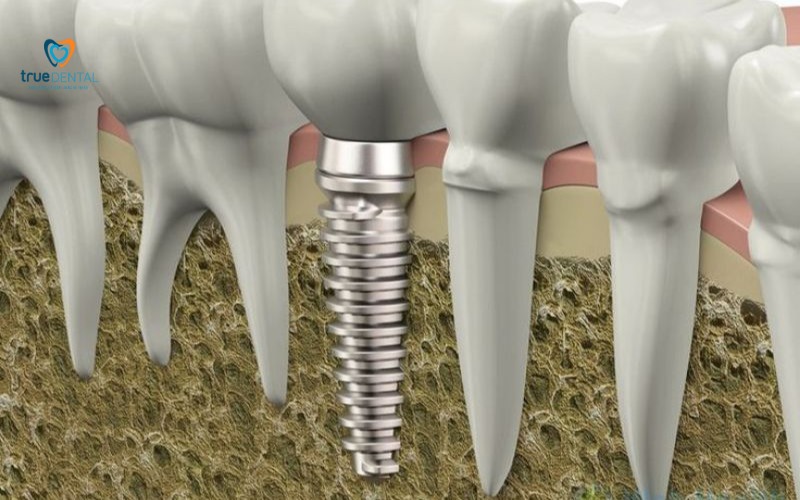 chi phí thay trụ implant cũ tại TP.HCM
