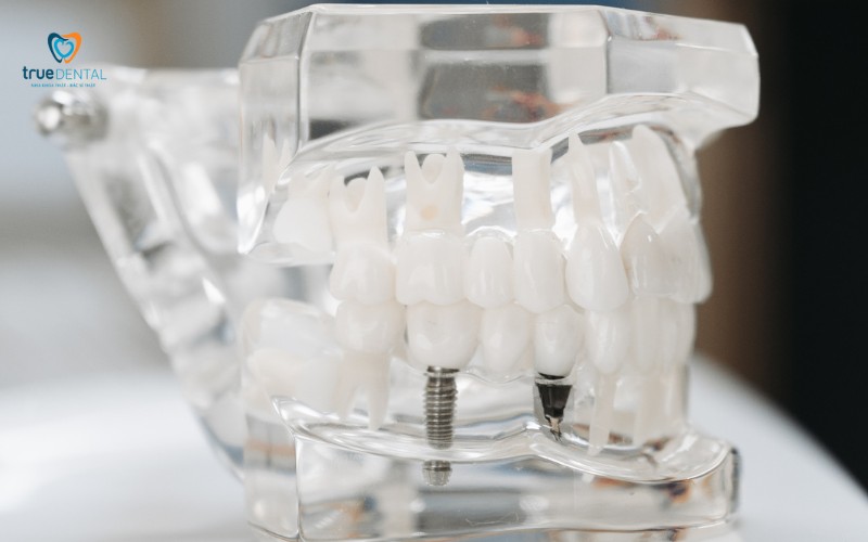 Địa chỉ cấy ghép Implant uy tín tại TP.HCM: Top 10 nha khoa hàng đầu 2025 13 địa chỉ cấy ghép implant uy tín tại TP.HCM