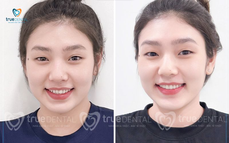 địa chỉ niềng răng uy tín tại Sài Gòn