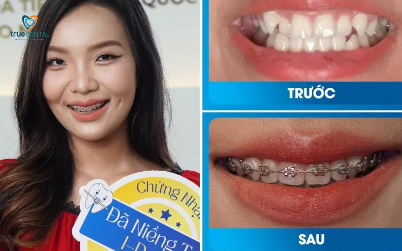 địa chỉ niềng răng uy tín tại Sài Gòn