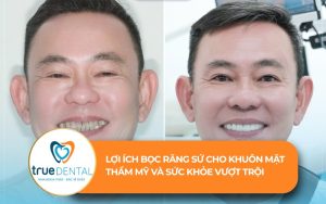 Lợi ích bọc răng sứ cho khuôn mặt