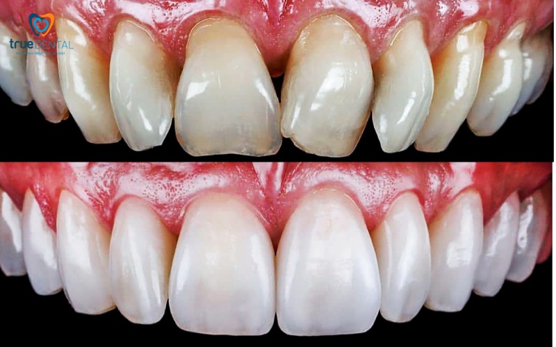 Lợi ích bọc răng sứ cho khuôn mặt: Thẩm mỹ và sức khỏe vượt trội 3 Lợi ích bọc răng sứ cho khuôn mặt