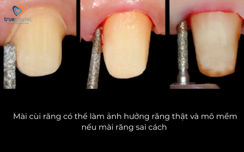 Lợi ích bọc răng sứ cho khuôn mặt: Thẩm mỹ và sức khỏe vượt trội 4 Lợi ích bọc răng sứ cho khuôn mặt