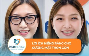 Lợi ích niềng răng cho khuôn mặt thon gọn
