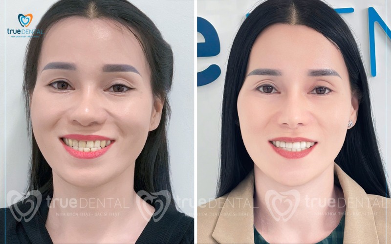 Lợi ích niềng răng cho khuôn mặt thon gọn